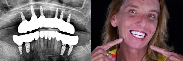 all-on-6-after-panoramic-mexico