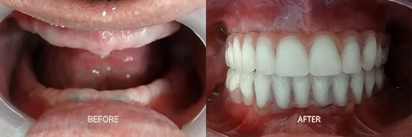 before-after-all-on-4-patient-09