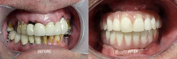 before-after-all-on-4-patient-10