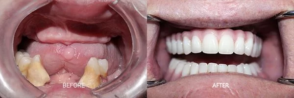 before-after-all-on-4-patient-11