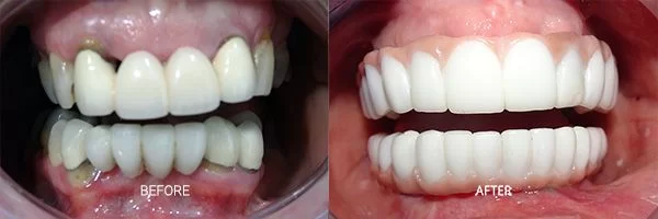 before-after-all-on-4-patient-12