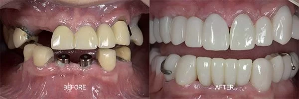 before-after-dental-implants-patient-04
