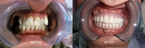 before-after-dental-implants-patient-05