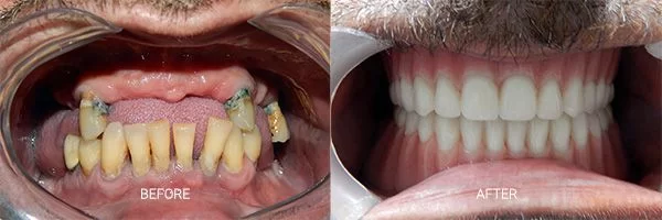 before-after-dental-implants-patient-06
