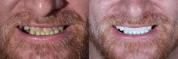 before-after-dental-veneers-cds-mexico-01