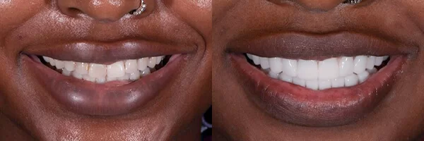 before-after-dental-veneers-cds-mexico-02
