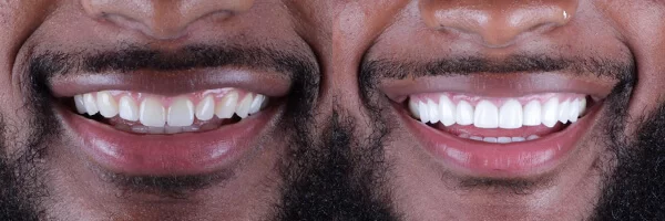 before-after-dental-veneers-cds-mexico-03