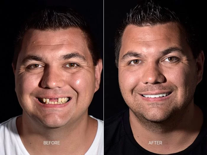 before-after-dental-work-mexico-CDS-03