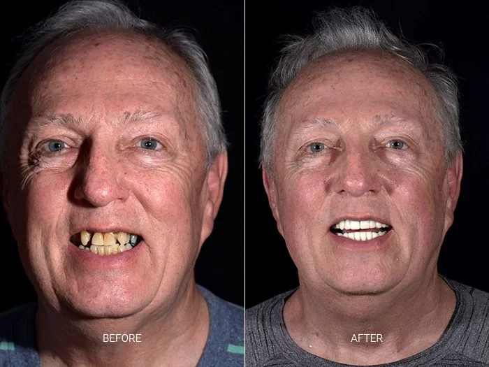 before-after-dental-work-mexico-CDS-06