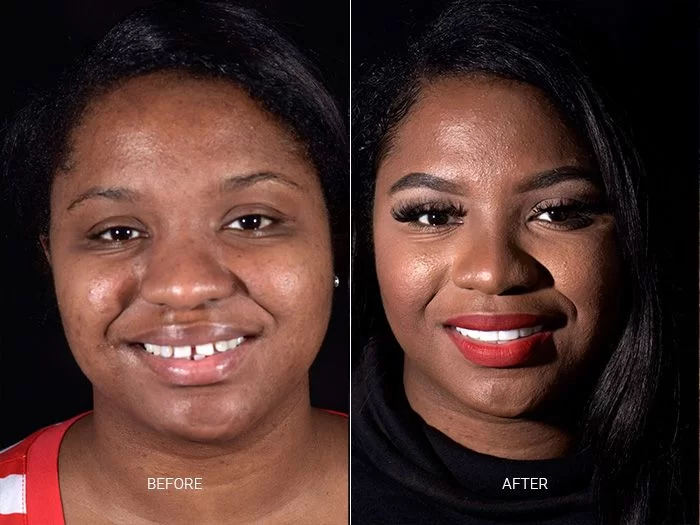 before-after-dental-work-mexico-CDS-11