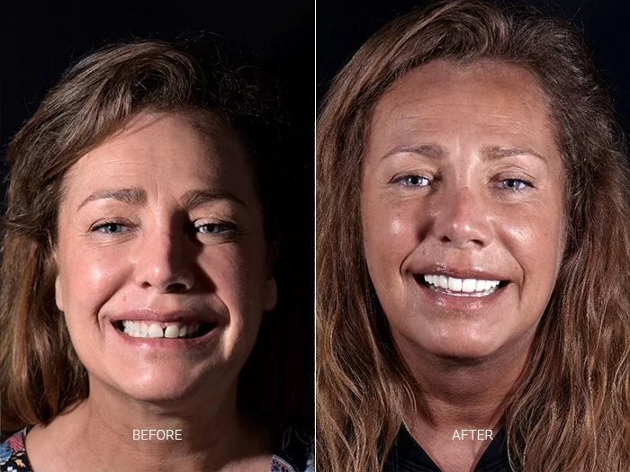 before-after-dental-work-mexico-CDS-12