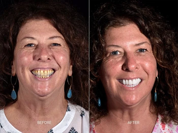 before-after-dental-work-mexico-CDS-13
