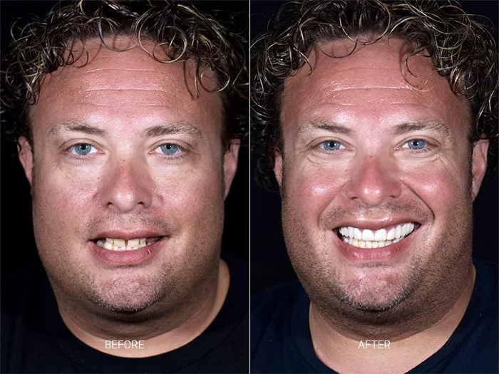 before-after-dental-work-mexico-CDS-14