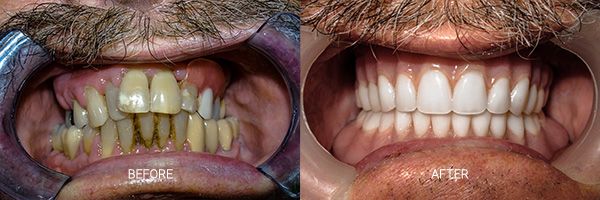 before-after-fixed-hybrid-dentures-patient-09