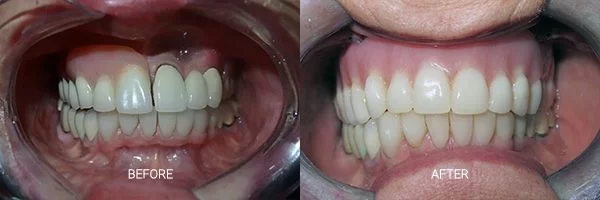 before-after-fixed-hybrid-dentures-patient-10