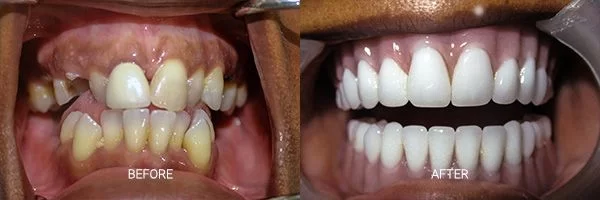 before-after-fixed-hybrid-dentures-patient-11