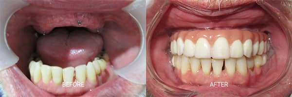 before-after-mini-dental-implants-patient-02