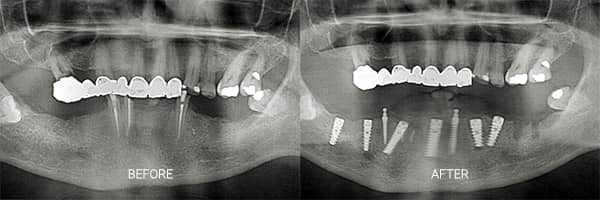 before-after-mini-dental-implants-patient-03