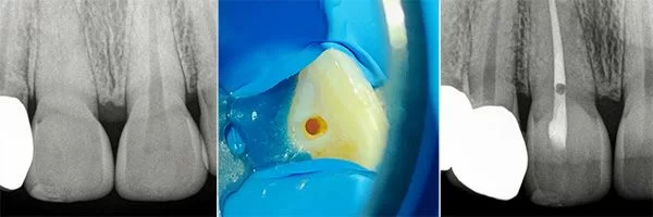 before-after-root-canals-patient-01