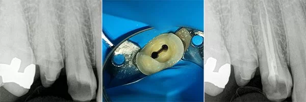 before-after-root-canals-patient-02