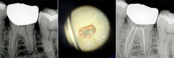 before-after-root-canals-patient-03