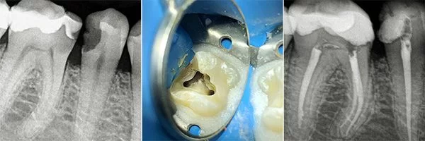 before-after-root-canals-patient-04