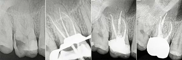 before-after-root-canals-patient-08