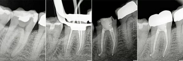 before-after-root-canals-patient-09