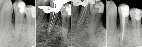 before-after-root-canals-patient-10