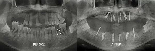before-after-snap-on-dentures-patient-08