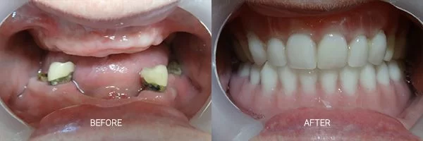 before-after-snap-on-dentures-patient-09