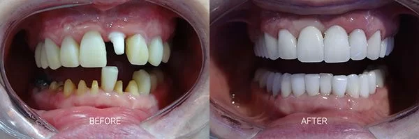 before-after-zirconia-dental-implant-patient-01