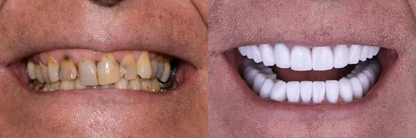 dental-implants-before-after-mexico-cancun-01