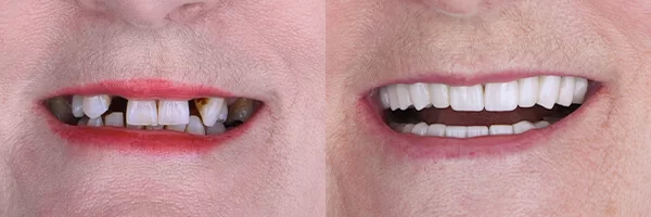 dental-implants-before-after-mexico-cancun-02-1