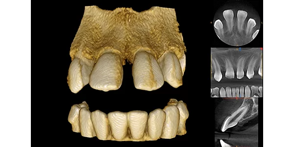 missing-incisors-lores