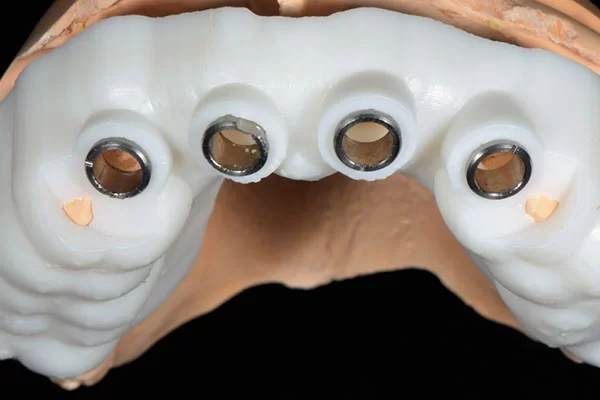 with-surgical-guides