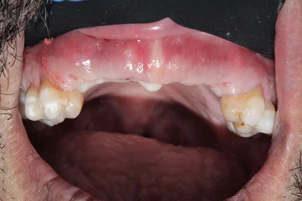 without-surgical-guides