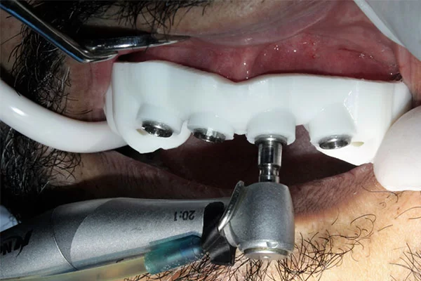 working-with-surgical-guides